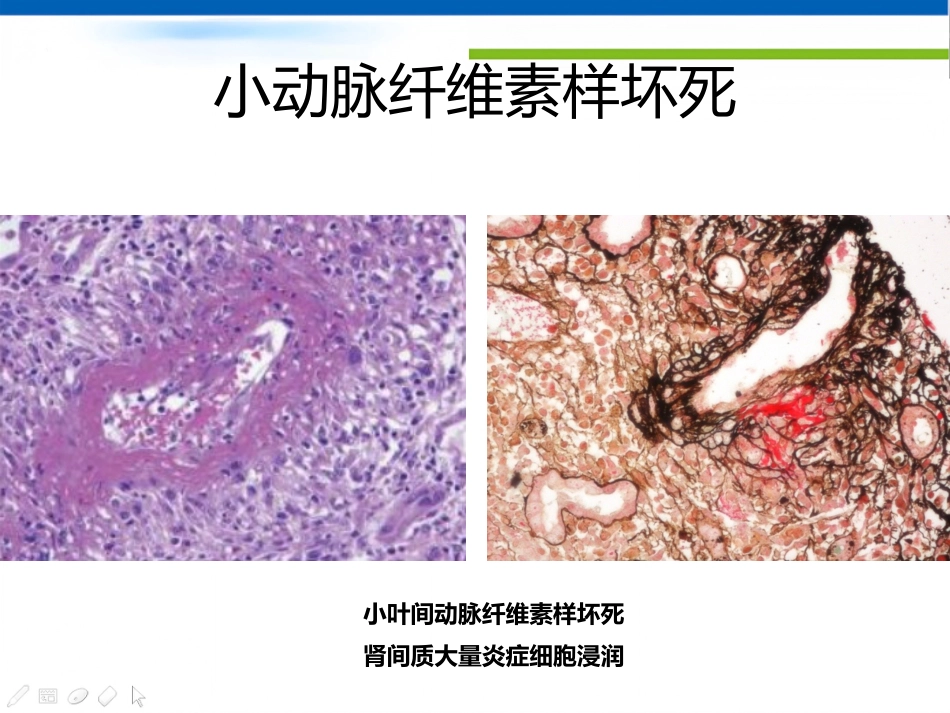 ANCA相关性血管炎肾损害病理表现_第7页