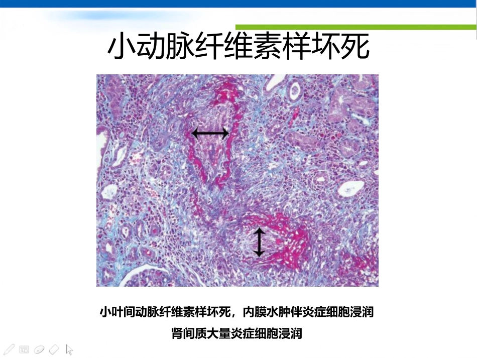 ANCA相关性血管炎肾损害病理表现_第8页