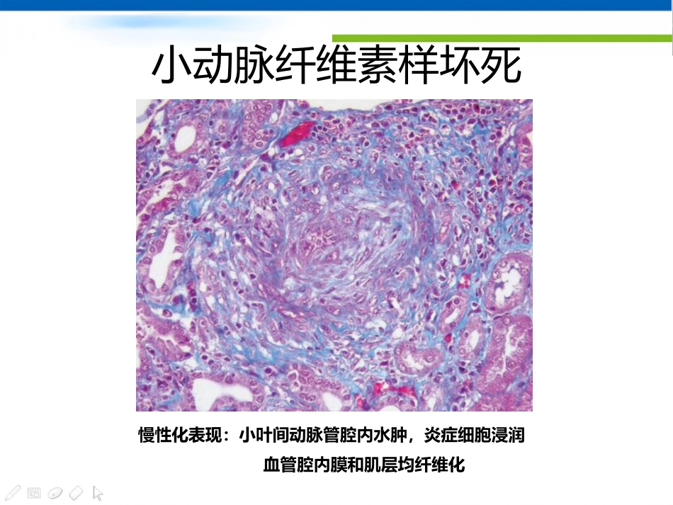 ANCA相关性血管炎肾损害病理表现_第9页