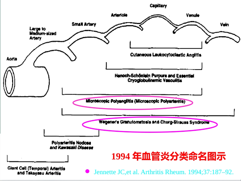 ANCA相关性血管炎的诊治进展 PPT_第14页