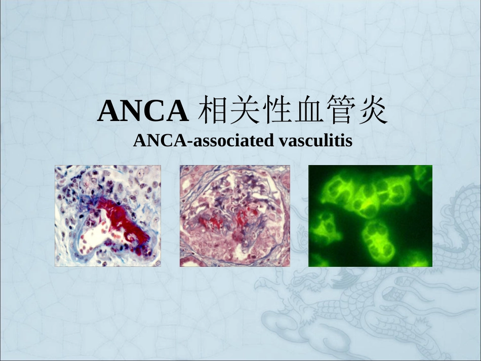 ANCA相关性血管炎ppt课件_第1页