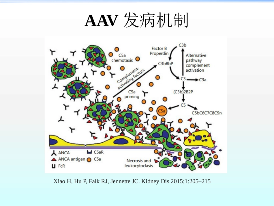 ANCA相关性血管炎ppt课件_第15页