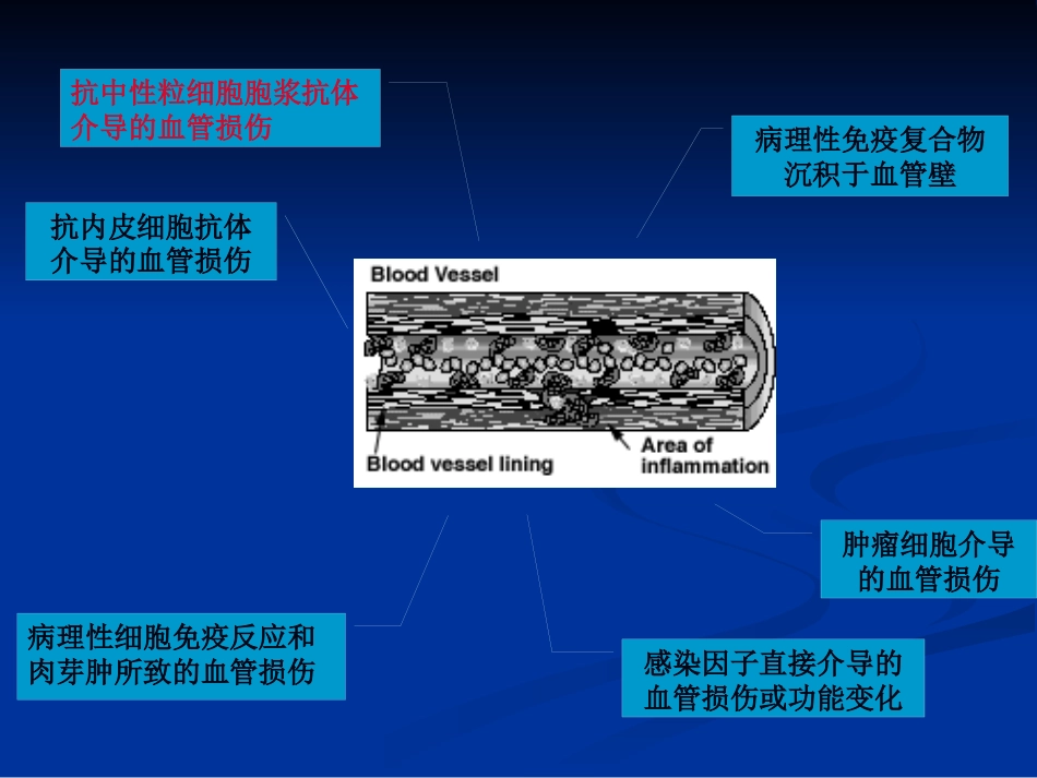 ANCA相关性血管炎ppt课件(1)_第5页