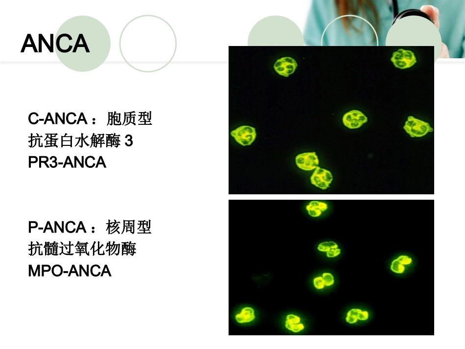 ANCA相关性血管炎PPT幻灯片_第10页