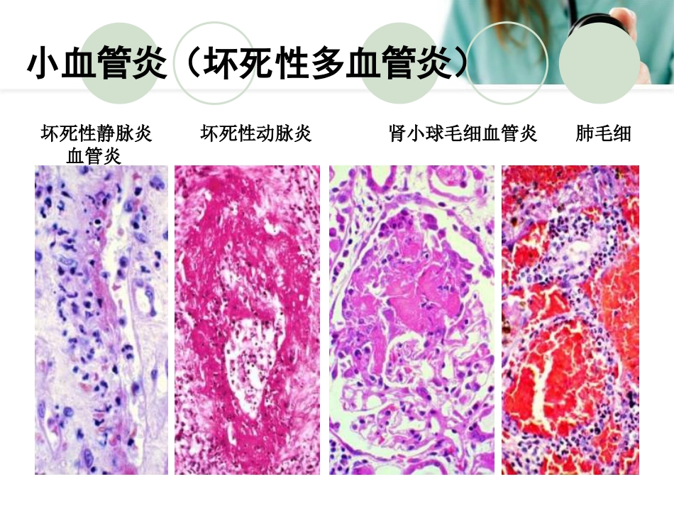 ANCA相关性血管炎PPT幻灯片_第4页