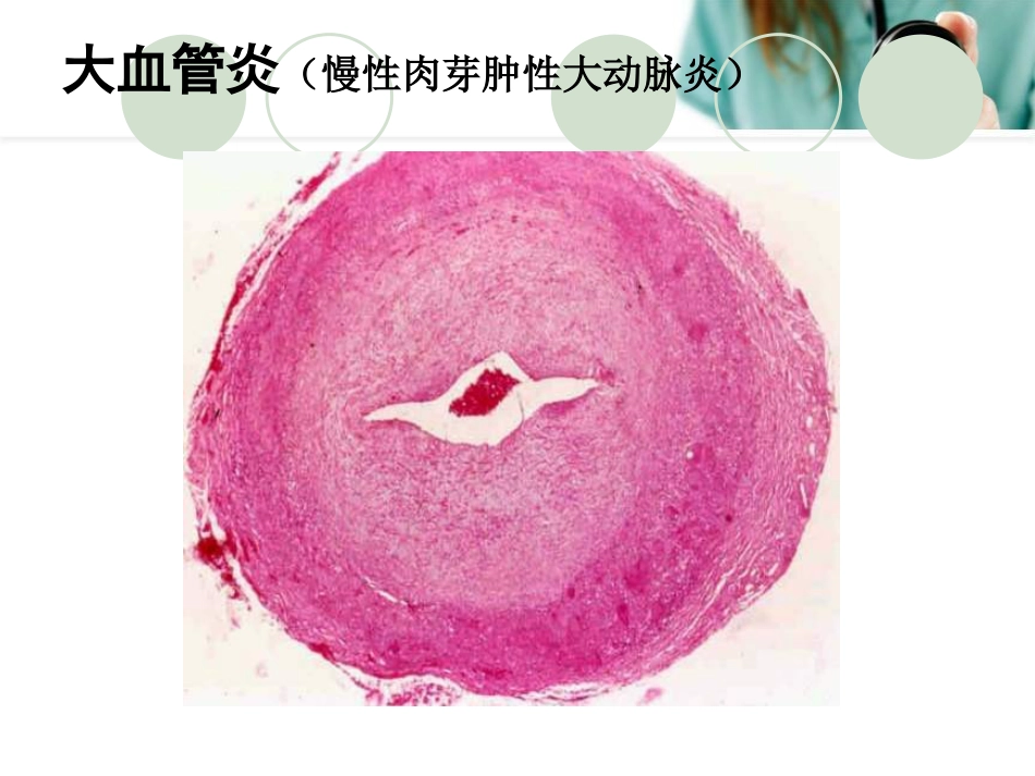 ANCA相关性血管炎PPT幻灯片_第5页