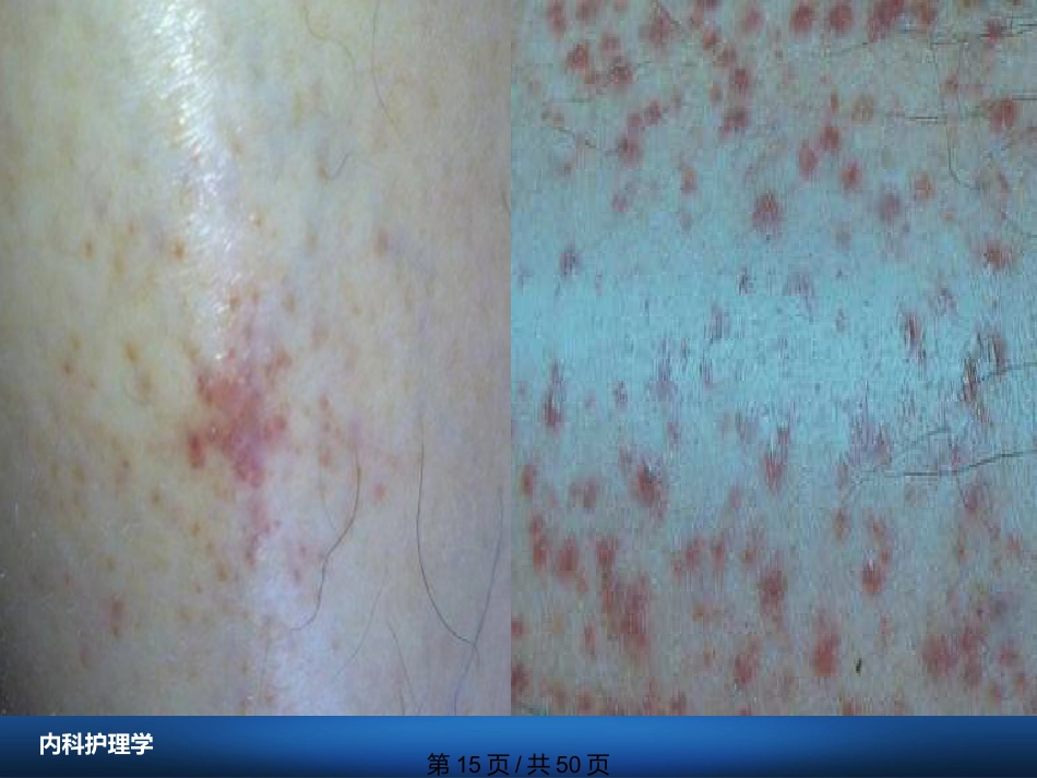 白血病病人护理_第15页