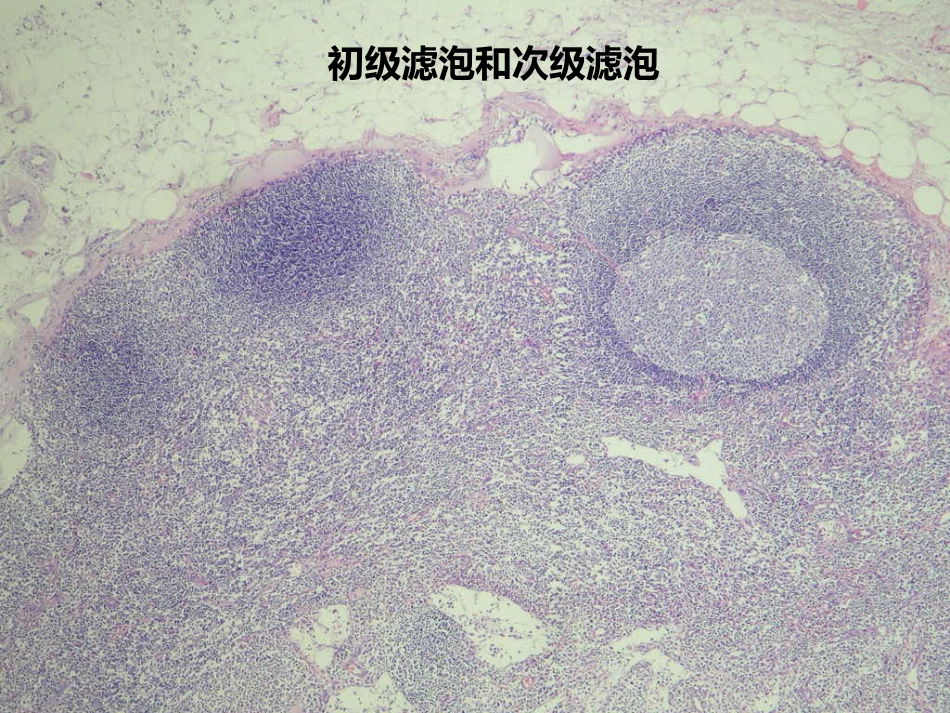lymphoma淋巴瘤 ppt课件_第10页