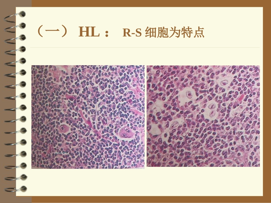 lymphoma淋巴瘤 ppt课件_第11页