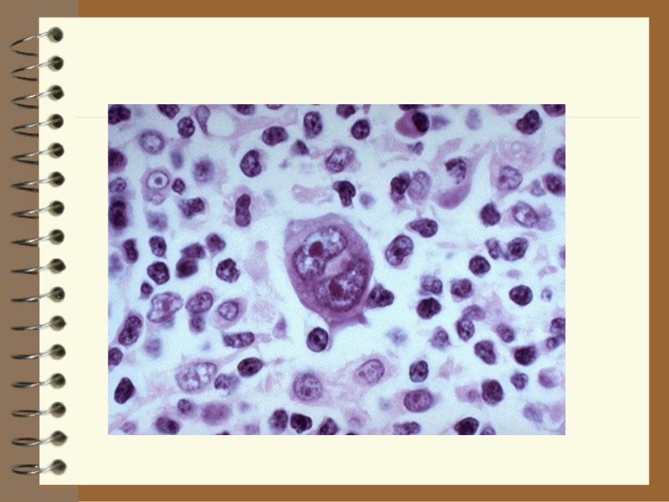 lymphoma淋巴瘤 ppt课件_第12页