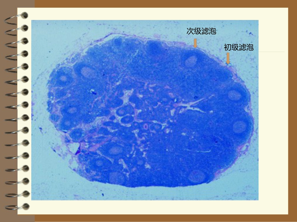 lymphoma淋巴瘤 ppt课件_第9页
