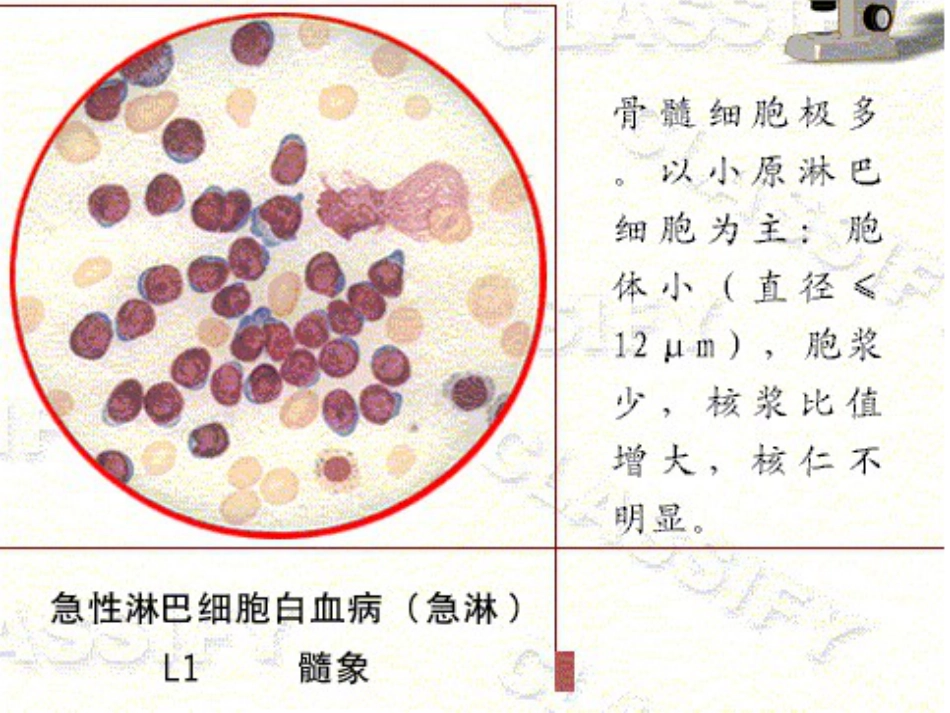 白血病的分型_第11页