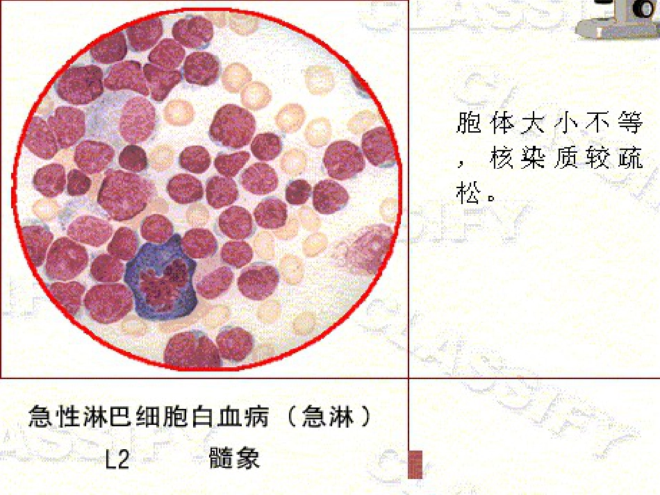 白血病的分型_第12页
