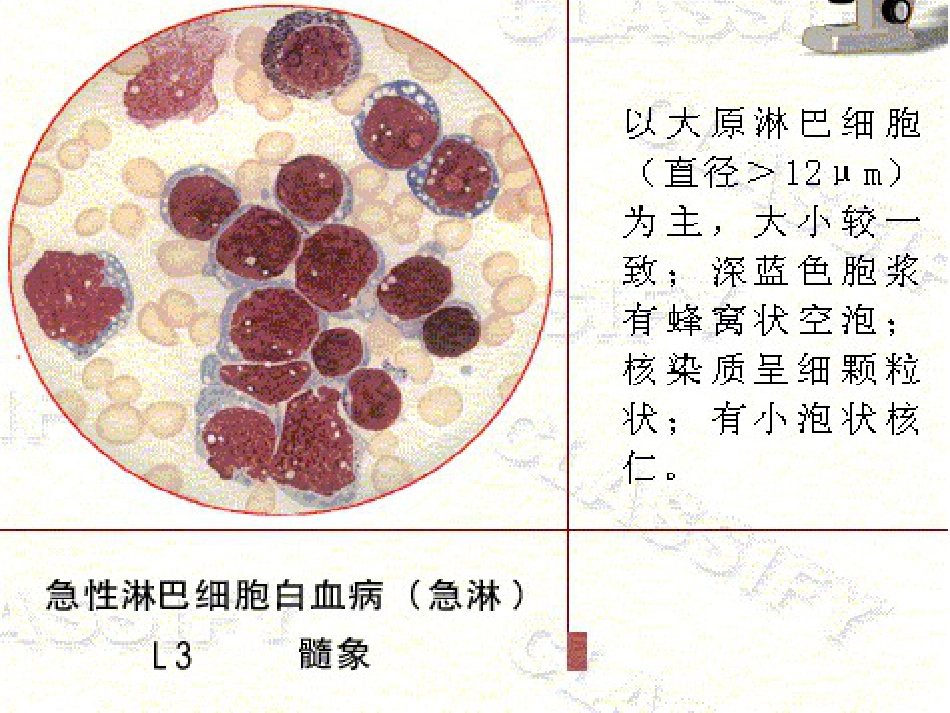 白血病的分型_第13页