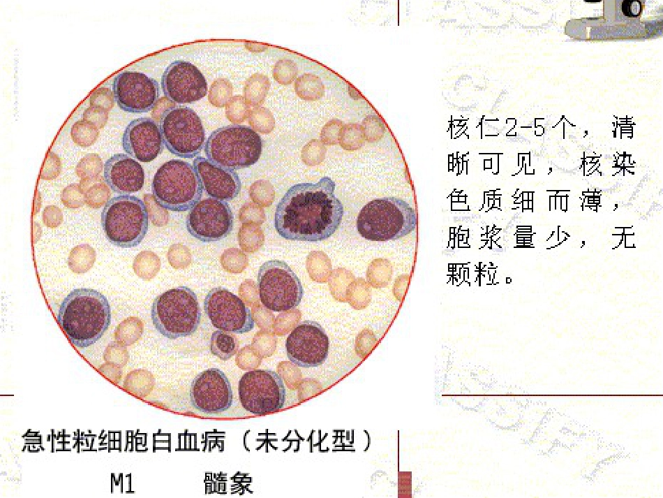 白血病的分型_第14页