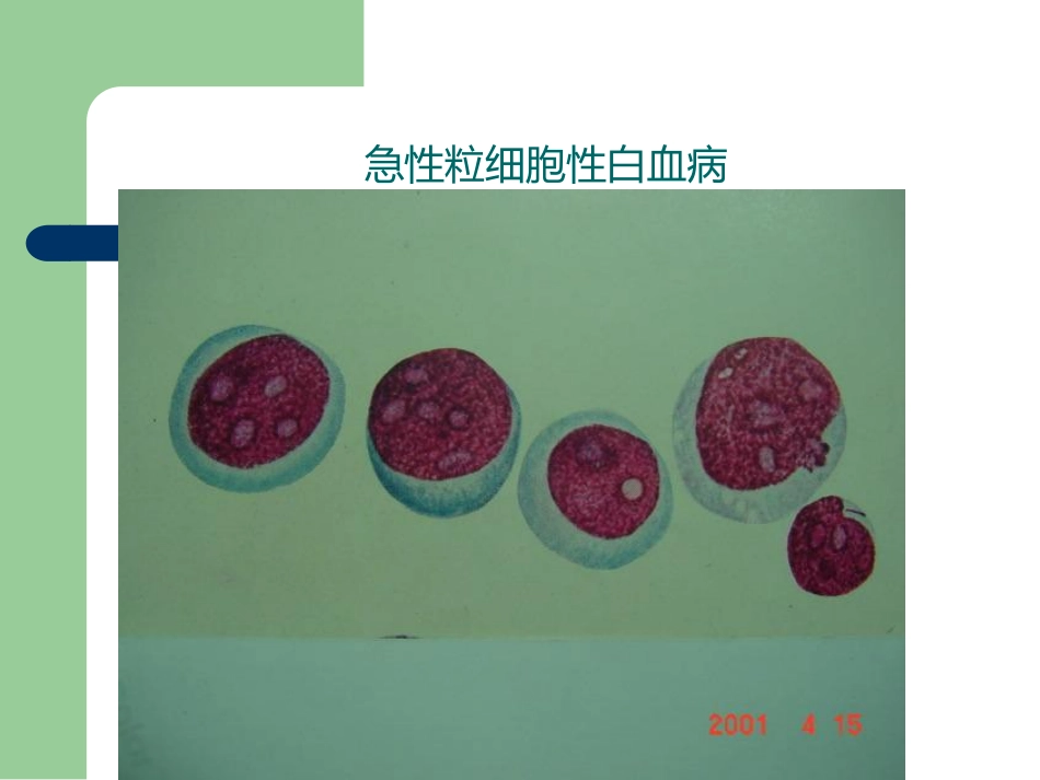 白血病治疗及护理评估_第15页
