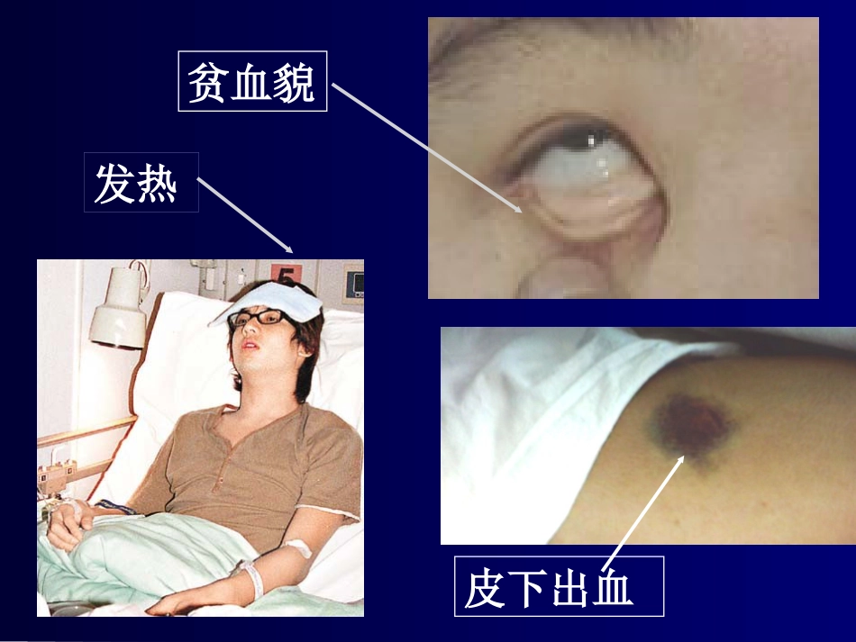白血病(7)_第15页