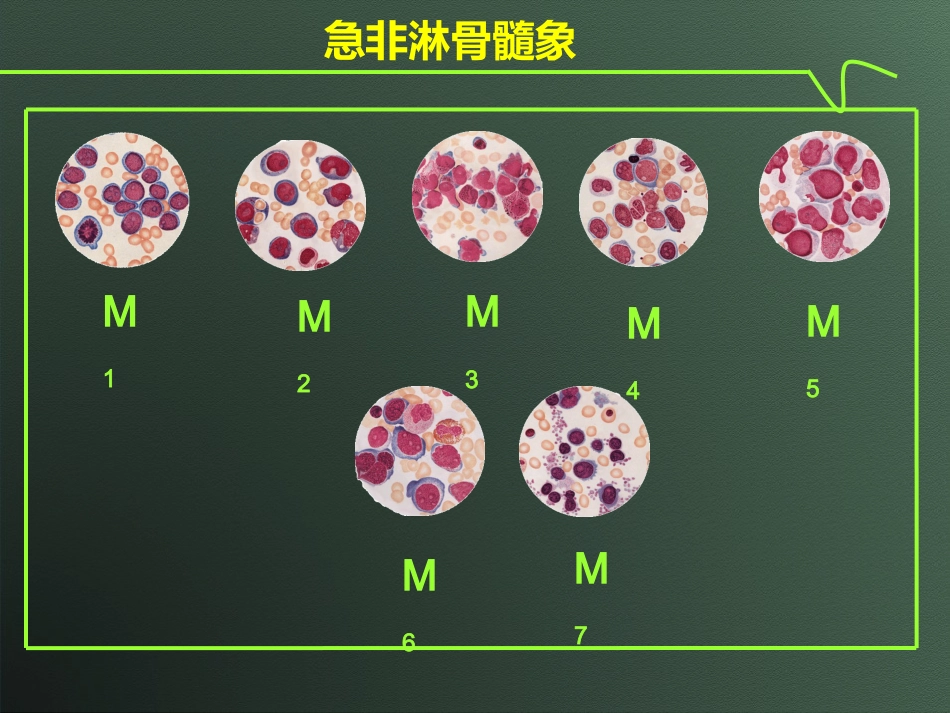 白血病(10)_第14页