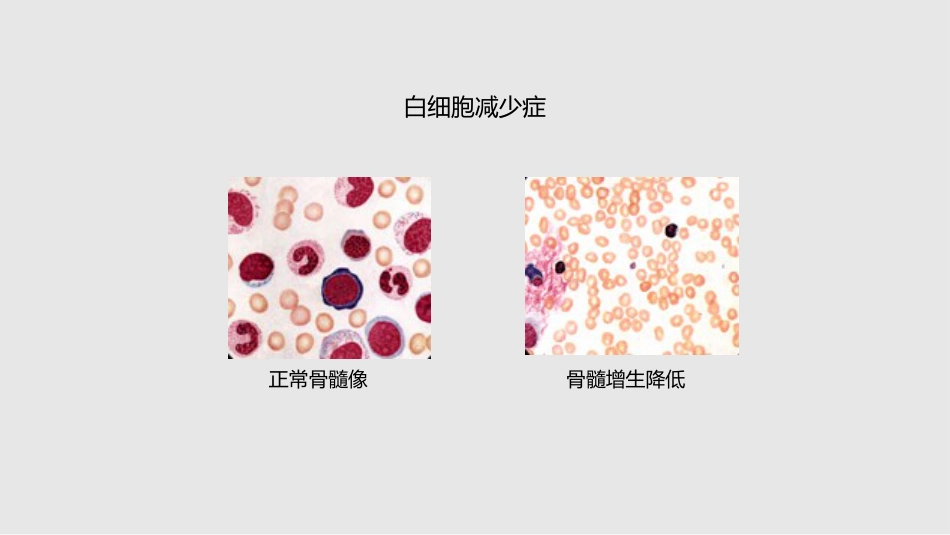 白细胞减少和粒细胞缺乏症11学习PPT教案_第10页