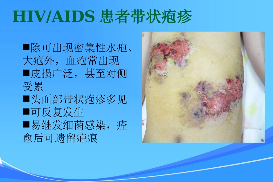 HIV皮肤与口腔表现_第10页