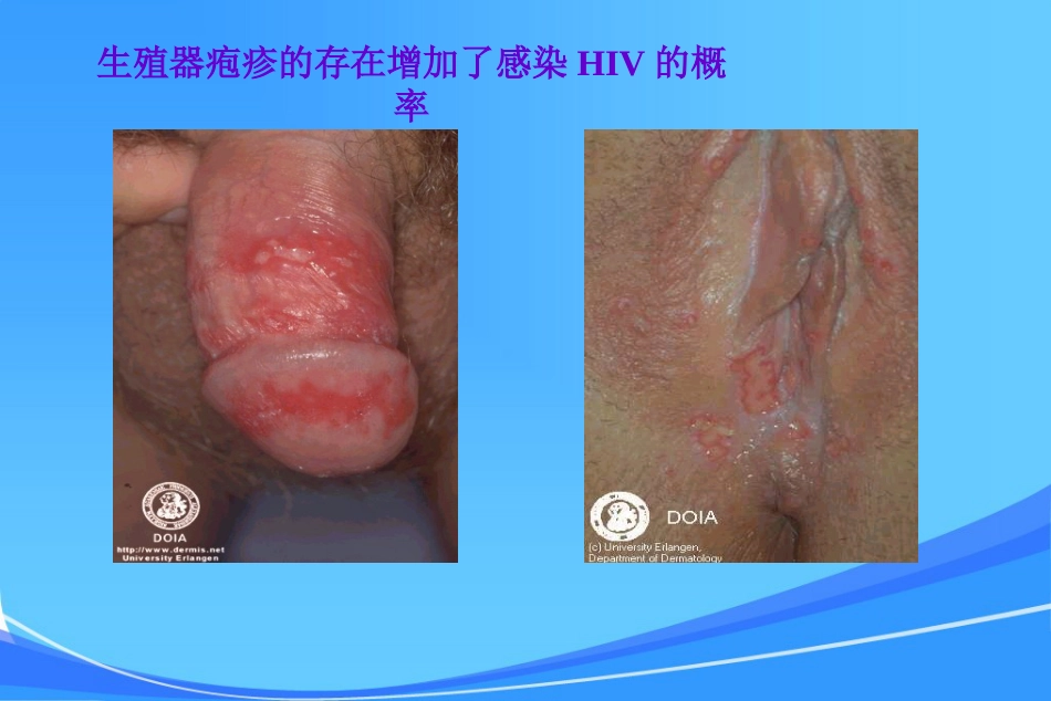 HIV皮肤与口腔表现_第15页