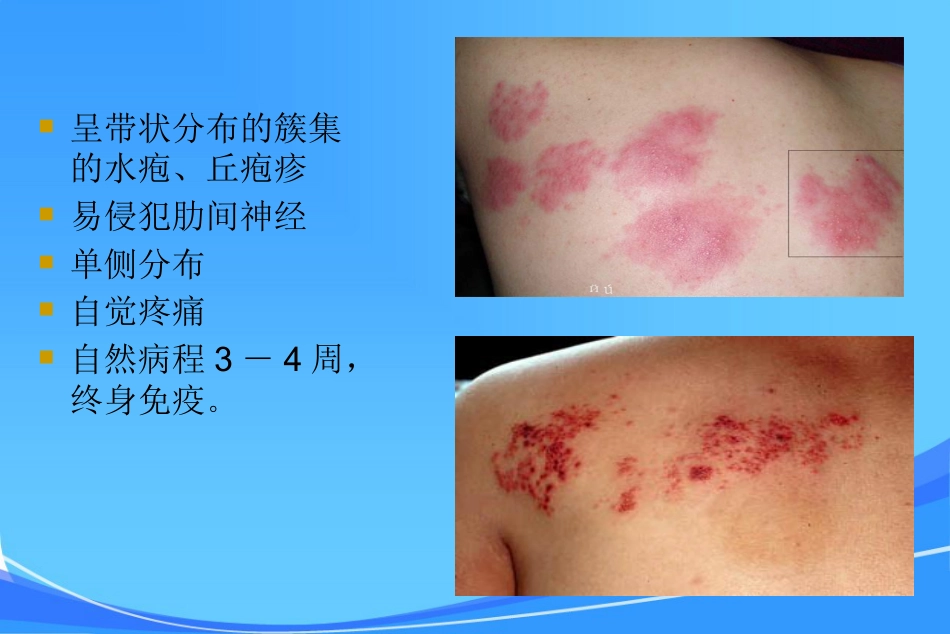 HIV皮肤与口腔表现_第8页