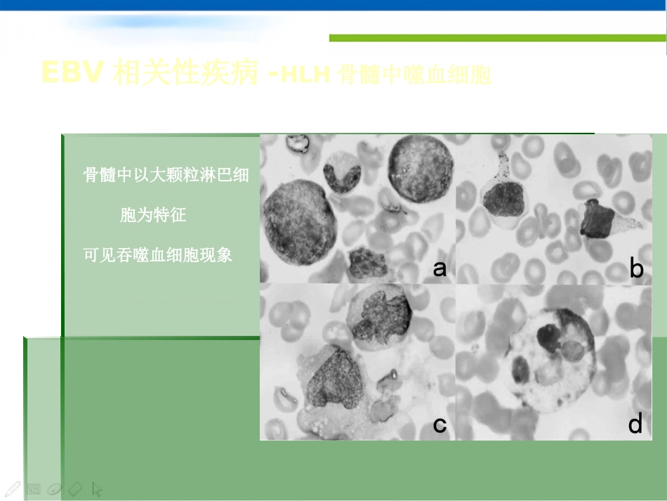 EBV相关性疾病_第14页