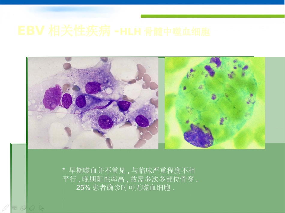 EBV相关性疾病_第15页