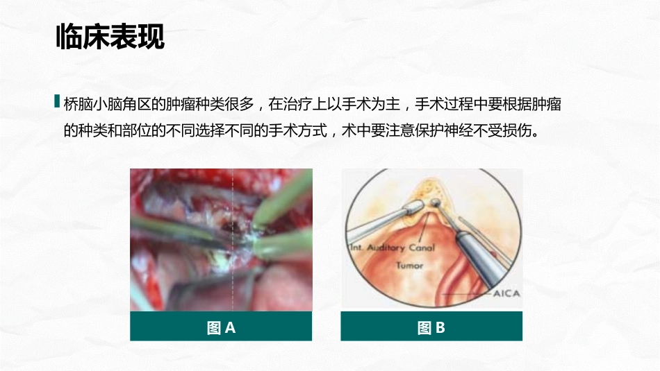 小脑肿瘤术后护理查房_第11页