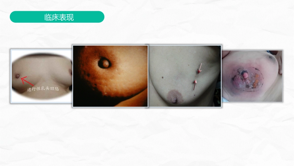 乳腺癌护理查房_第8页