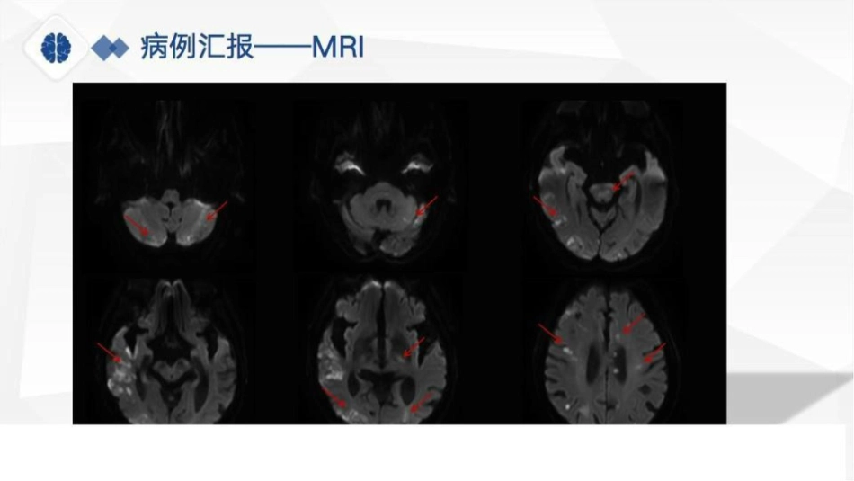 特鲁索综合征病理分享、病因及鉴别诊断_第5页