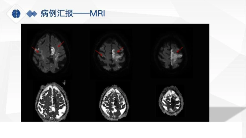 特鲁索综合征病理分享、病因及鉴别诊断_第6页