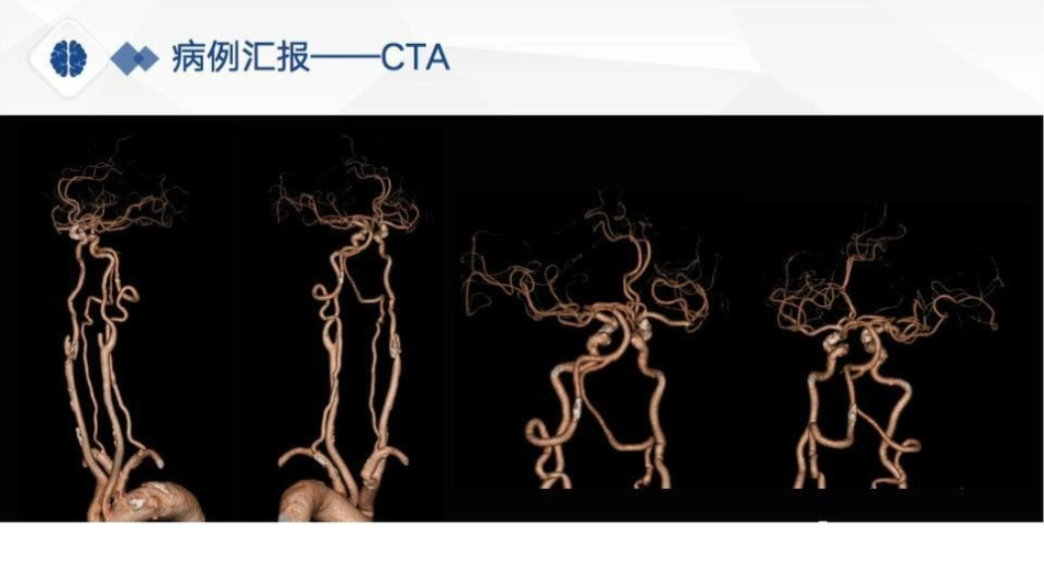 特鲁索综合征病理分享、病因及鉴别诊断_第9页