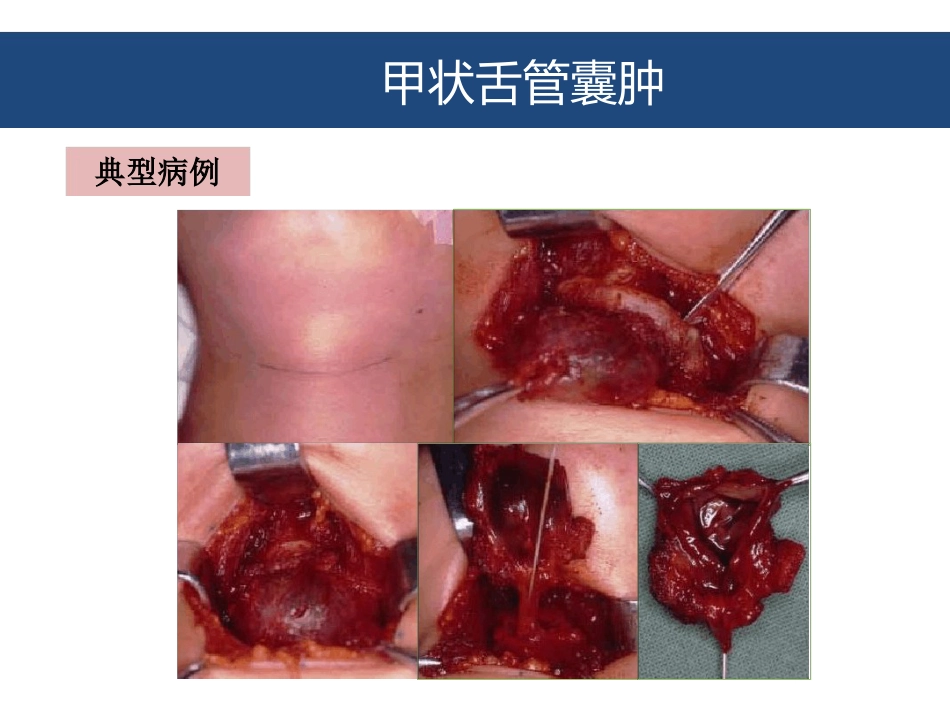 口腔颌面部囊肿及良性肿瘤_第11页
