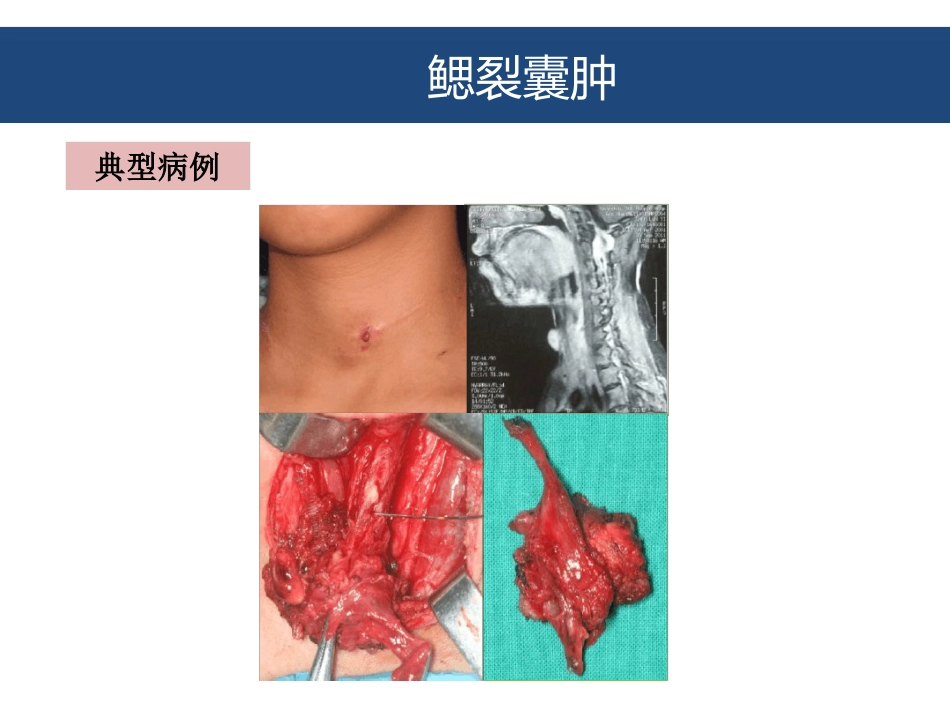 口腔颌面部囊肿及良性肿瘤_第15页