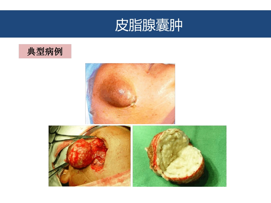 口腔颌面部囊肿及良性肿瘤_第5页