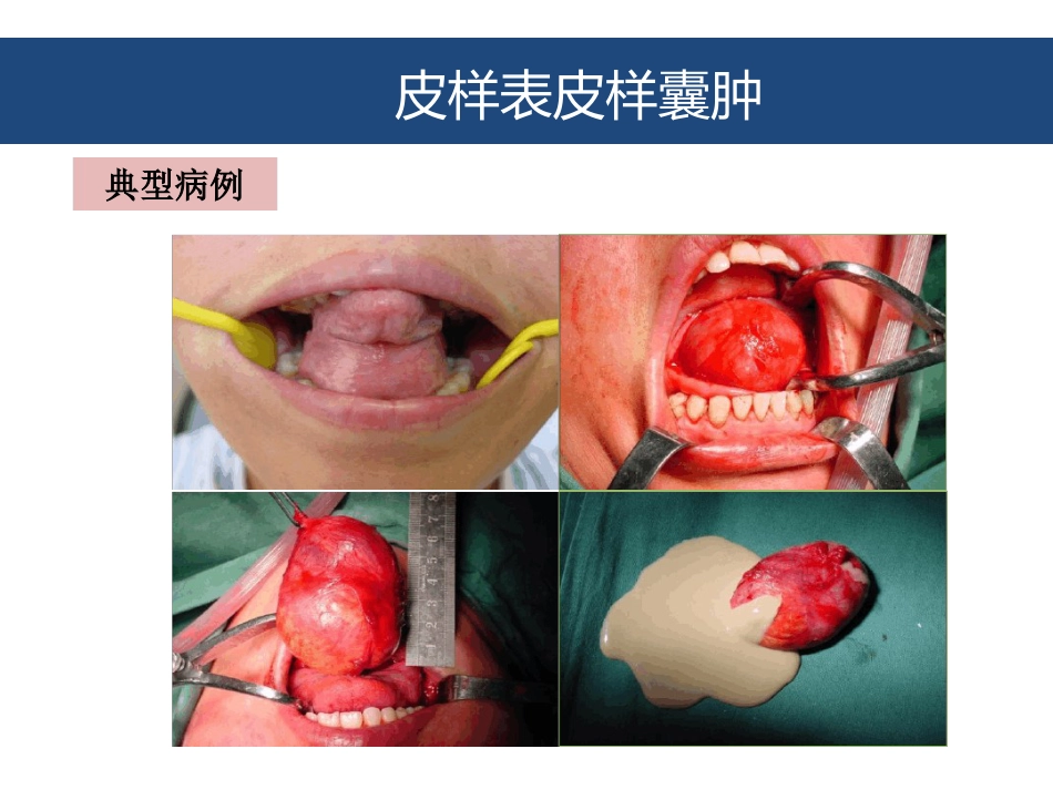 口腔颌面部囊肿及良性肿瘤_第8页