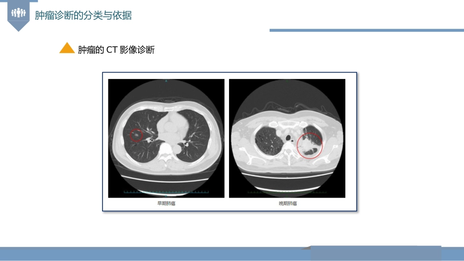 肿瘤的诊断与T-N-M分期_第12页