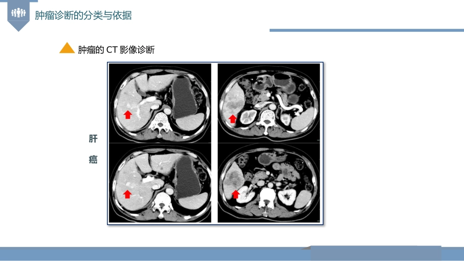 肿瘤的诊断与T-N-M分期_第13页