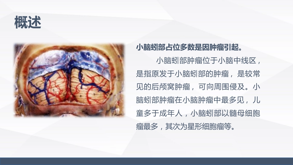 小脑蚓部占位的业务学习_第5页
