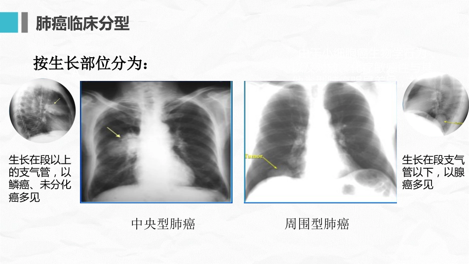 肺癌护理查房_第13页