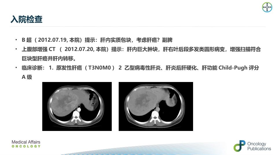 肝癌二线治疗瑞戈非尼_第3页