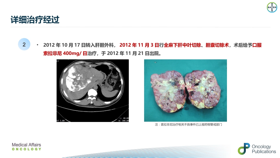 肝癌二线治疗瑞戈非尼_第5页