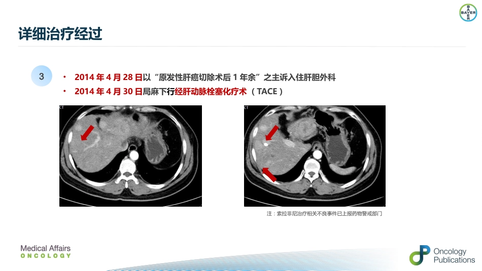 肝癌二线治疗瑞戈非尼_第6页