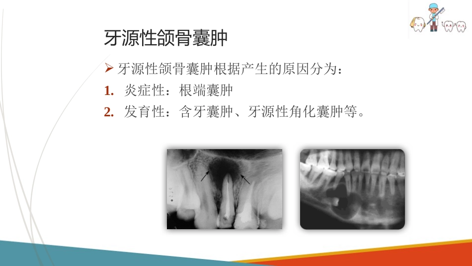 口腔颌面部肿瘤—口腔颌面部颌骨囊肿_第10页
