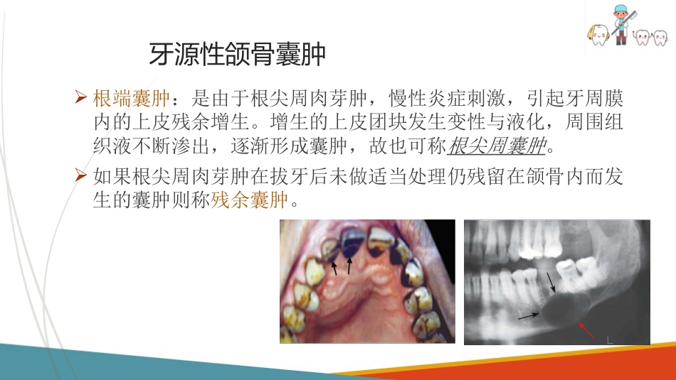 口腔颌面部肿瘤—口腔颌面部颌骨囊肿_第11页