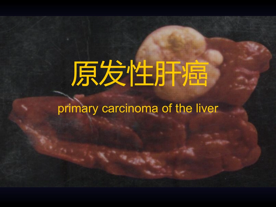 肝癌(2)_第2页