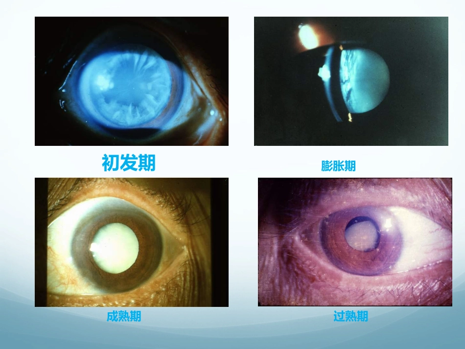 白内障_第13页