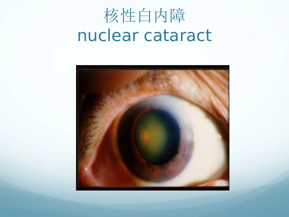 白内障_第14页