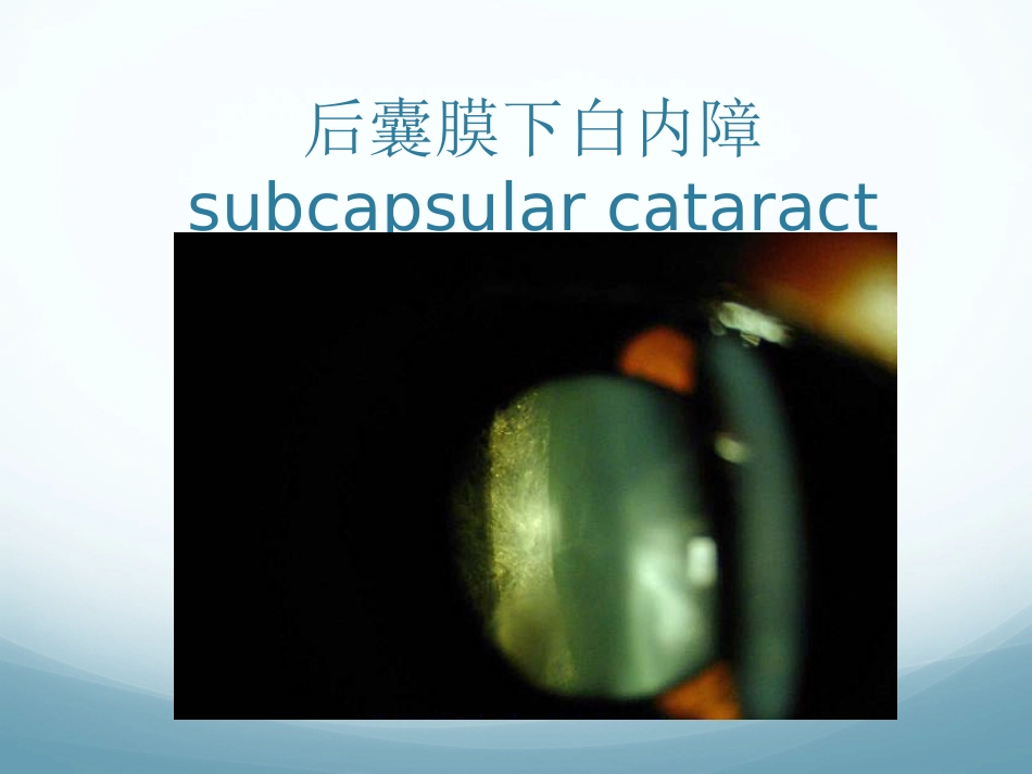 白内障_第15页
